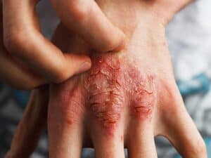 Psoriasis Treatment