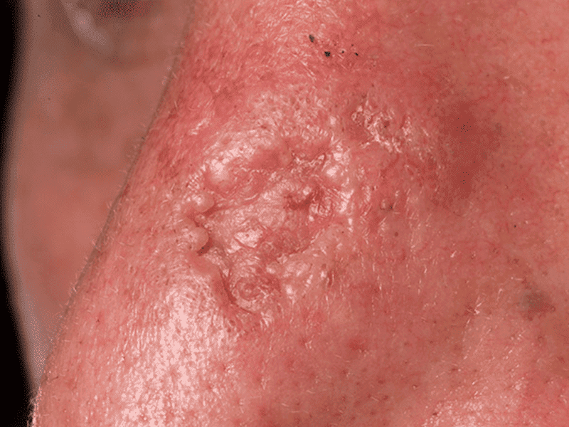 basal-cell-carcinoma-st-michaels-clinic