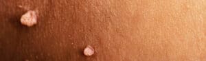 lumps and bumps