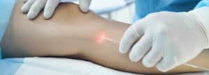 evla vein treatment