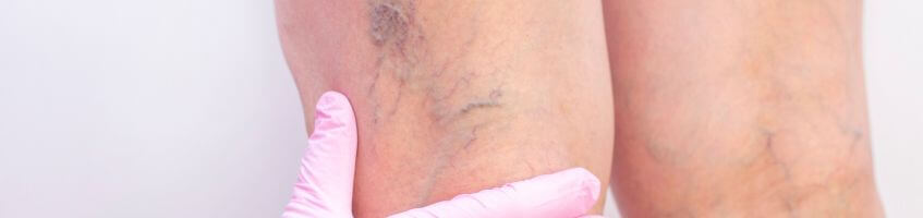 thread veins treatment