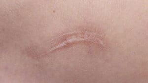 Keloid Scars