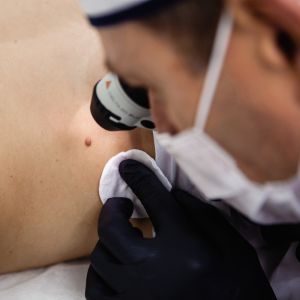 checking moles