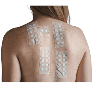 SKIN ALLERGY PATCH TEST Shrewsbury
