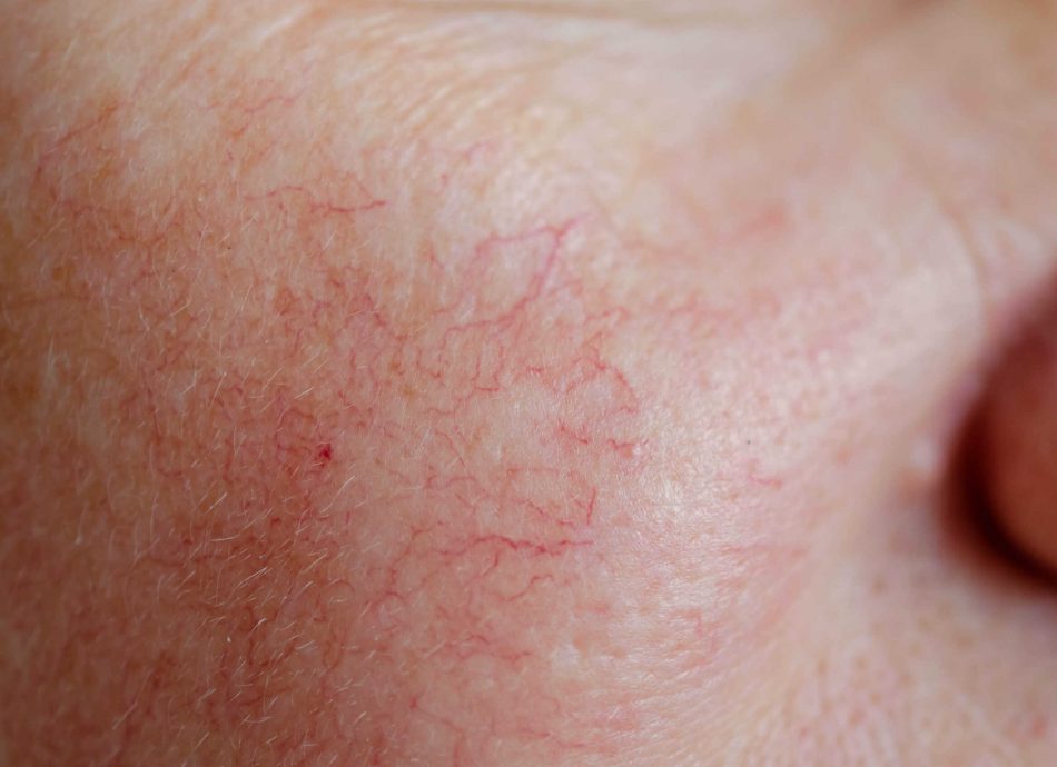 spider-veins-thread-vein-and-rosacea-scaled-1-1.jpg